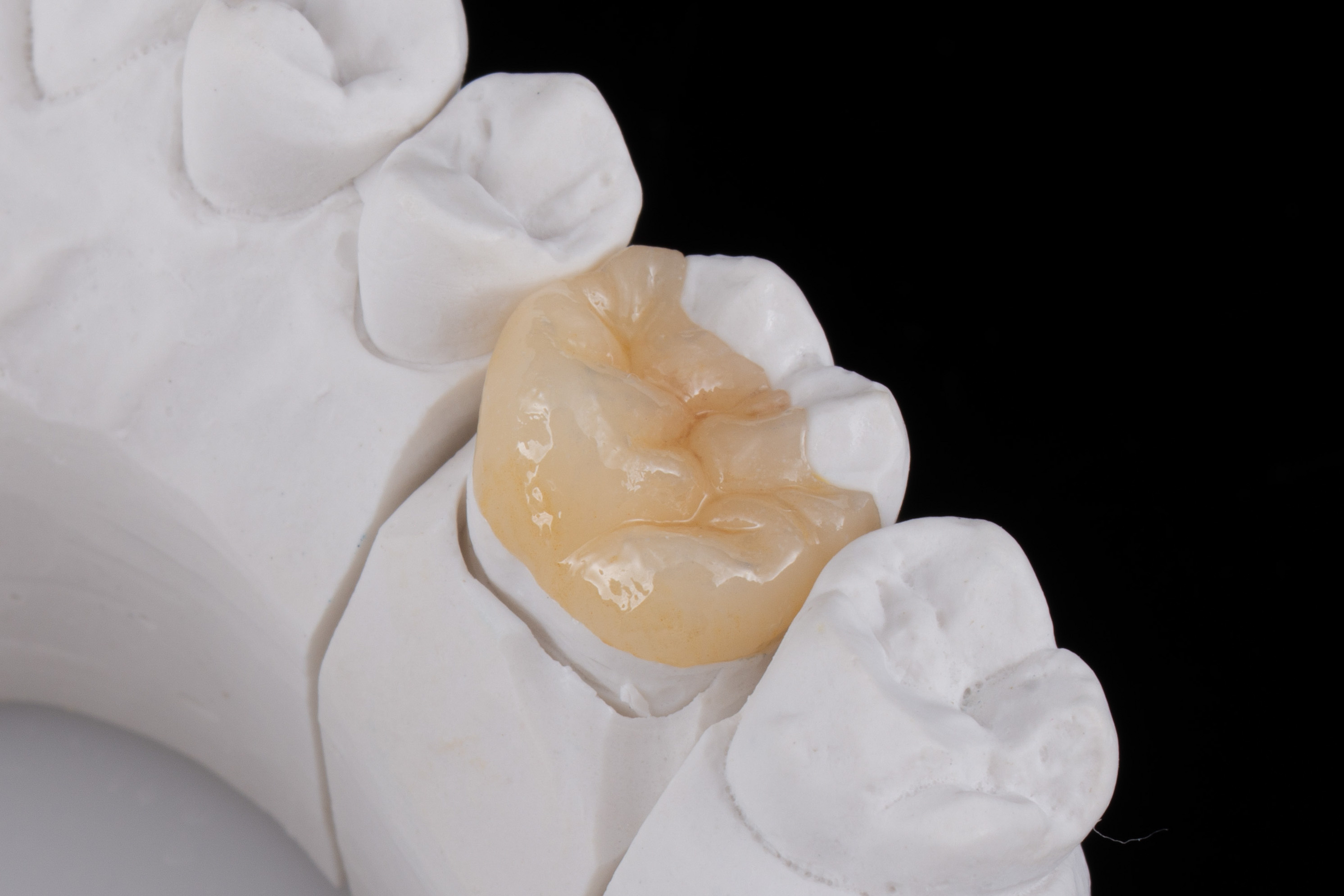 Lithium (di)silicate: Strength & Aesthetics | Dr José Ignacio Zorzin