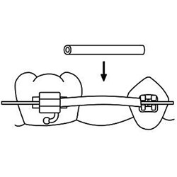 NAOL Clear Tissue Guard, .027 - 10' Spool