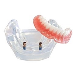 Locator Model Lower Denture