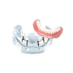 LOC Overdenture Implant Model