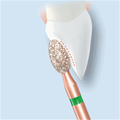 03di_KP6379_Frontzahn_601