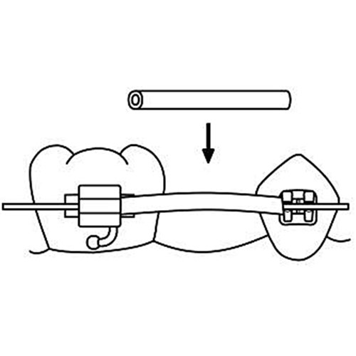 NAOL Clear Tissue Guard, .018 - 10' Spool