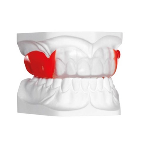 Scheu Bioplast Xtreme Kit - 125 x 5.0mm - Red - Round, 1-Pack