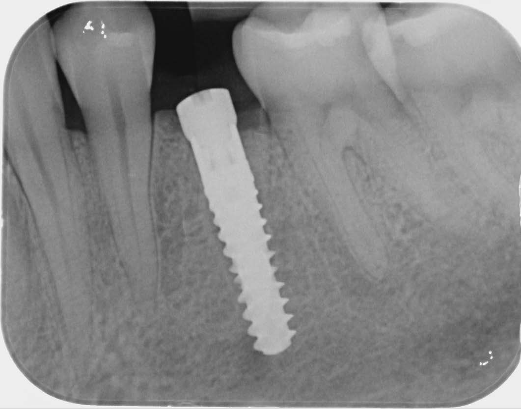 Figure 6: Postoperative X-ray image of region 34, condition after immediate implantation.